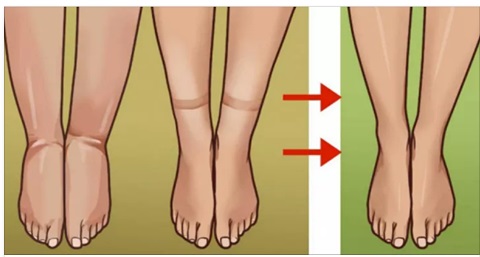 ECCO L'UNICO MODO PER RIDURRE IL GONFIORE ALLE GAMBE SE SOFFRI DI RITENZIONE IDRICA - 17/04/2017